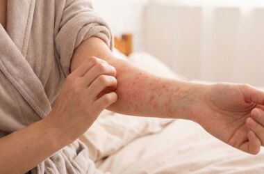 pielęgnacja skóry z AZS, jak pielęgnować skórę z AZS, AZS na kobiecym przedramieniu