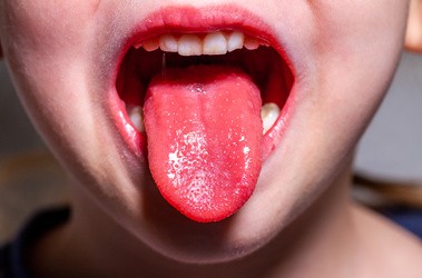 Malinowy język u dziecka
