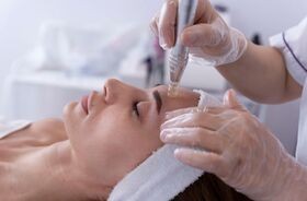 Mezoterapia mikroigłowa z użyciem DNA łososia (nasienia łososia). 