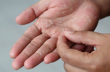 wyprysk potnicowy dłoni