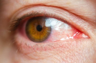 Przekrwione oczy u dzieci i dorosłych – co mogą oznaczać? Co stosować na zaczerwienione oko?