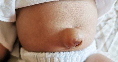 Przepuklina pępkowa u niemowląt – przyczyny i objawy. Jak wygląda leczenie przepukliny pępkowej u noworodka?