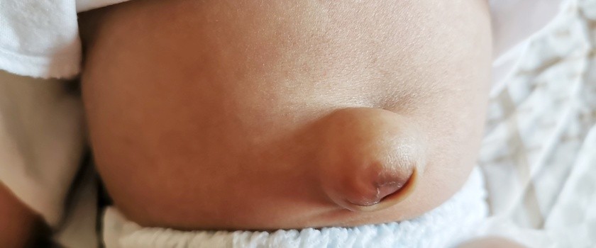 Przepuklina pępkowa u niemowląt – przyczyny i objawy. Jak wygląda leczenie przepukliny pępkowej u noworodka?
