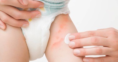 Pieluszkowe zapalenie skóry – przyczyny, leczenie. Jak dbać o skórę dziecka z uczuleniem pieluszkowym?