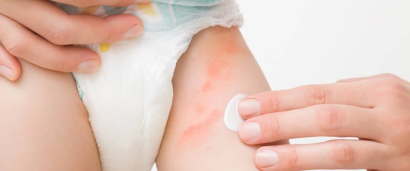 Pieluszkowe zapalenie skóry – przyczyny, leczenie. Jak dbać o skórę dziecka z uczuleniem pieluszkowym?