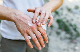 Pęcherzowe oddzielanie się naskórka na dłoniach