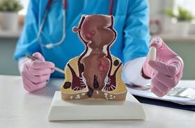 lekarz proktolog i model odbytnicy, badanie per rectum, badanie protktologiczne, jak wygląda badanie per rectum