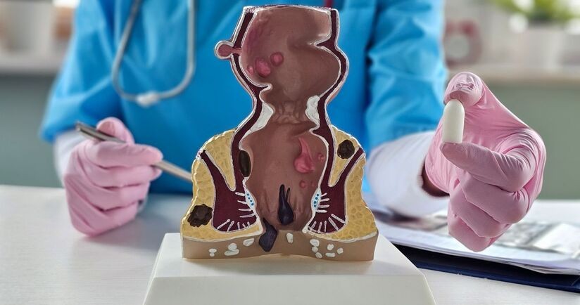 lekarz proktolog i model odbytnicy, badanie per rectum, badanie protktologiczne, jak wygląda badanie per rectum