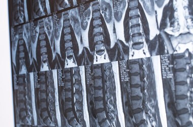 Stenoza – przyczyny, objawy, leczenie, rehabilitacja przy zwężeniu kanału kręgowego