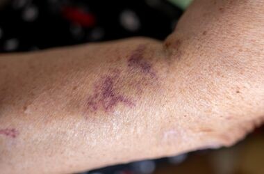 wylew podskórny na ręku starszej osoby, wylewy podskórne u osób starszych, przyczyny wylewów podskórnych u seniora