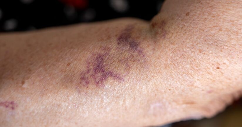 wylew podskórny na ręku starszej osoby, wylewy podskórne u osób starszych, przyczyny wylewów podskórnych u seniora