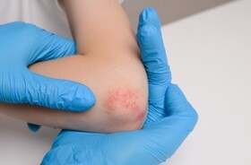 alergia kontaktowa, wyprysk kontaktowy, wyprysk alergiczny, alergia skórna, pokrzywka na skórze