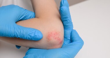 alergia kontaktowa, wyprysk kontaktowy, wyprysk alergiczny, alergia skórna, pokrzywka na skórze