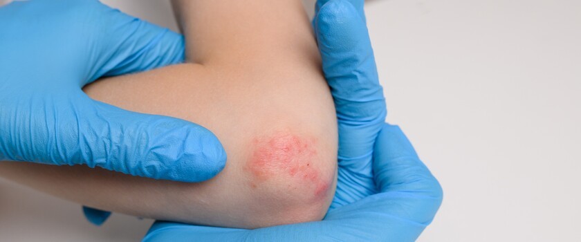 alergia kontaktowa, wyprysk kontaktowy, wyprysk alergiczny, alergia skórna, pokrzywka na skórze
