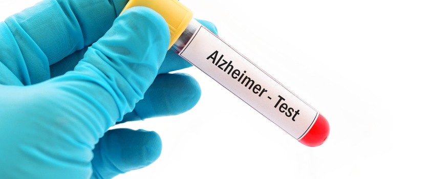 Test wykryje Alzheimera nawet z 20–letnim wyprzedzeniem