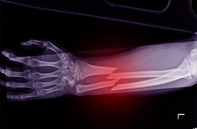 Złamanie kości - widok zdjęcia rentgenowskiego