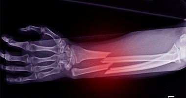 Złamanie kości - widok zdjęcia rentgenowskiego
