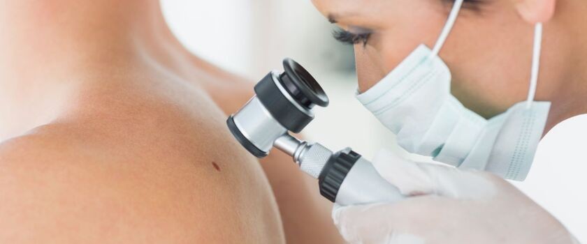 Czerniak to nowotwór złośliwy skóry. Każdy podejrzany pieprzyk powinien zobaczyć dermatolog.
