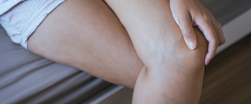 kobiece nogi, założona jedna na drugą, z widoczymi naczyniami krwionośnymi