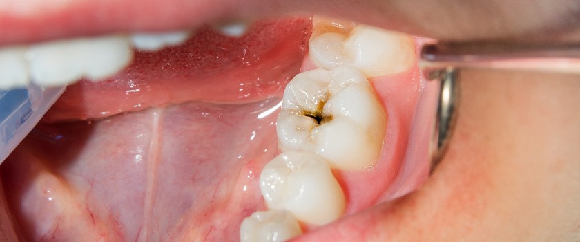 Zmiana próchnicowa na zębie