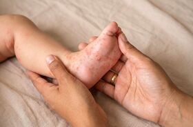 wysypka u dziecka, przyczyny wysypki u dziecka
