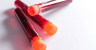 Glikemia – badanie, wskazanie, normy. Jak interpretować wyniki poziomu cukru we krwi?
