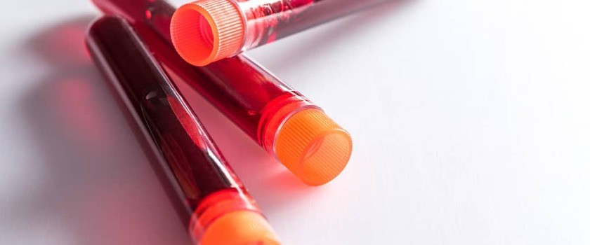 Glikemia – badanie, wskazanie, normy. Jak interpretować wyniki poziomu cukru we krwi?
