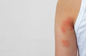 suche plamy na skórze, suche czerwone plamy na skórze