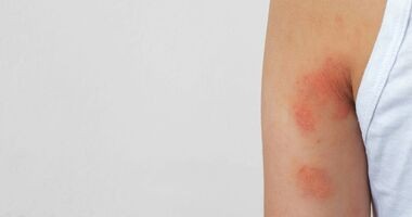 suche plamy na skórze, suche czerwone plamy na skórze