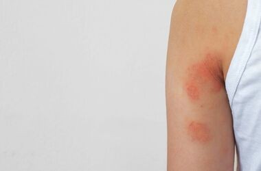 suche plamy na skórze, suche czerwone plamy na skórze