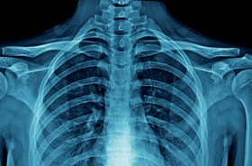 Sklerotyzacja – czym jest sklerotyzacja kości? Leczenie i rehabilitacja w chorobach przebiegających ze sklerotyzacją podchrzęsną