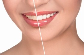 Wybielanie zębów - przegląd preparatów aptecznych