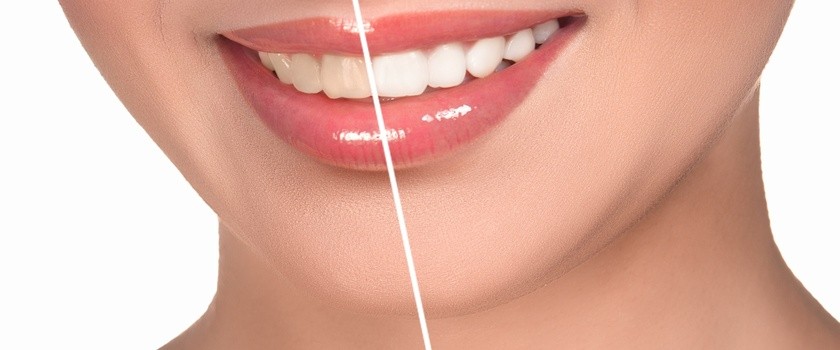 Wybielanie zębów - przegląd preparatów aptecznych