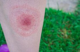 rumień wędrujący, rumień wędrujący na kobiecej łydce, jak rozpoznać rumień wędrujący, rumień wędrujący zdjęcia