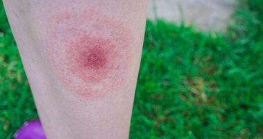 rumień wędrujący, rumień wędrujący na kobiecej łydce, jak rozpoznać rumień wędrujący, rumień wędrujący zdjęcia