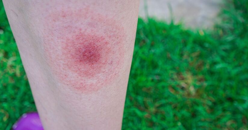 rumień wędrujący, rumień wędrujący na kobiecej łydce, jak rozpoznać rumień wędrujący, rumień wędrujący zdjęcia