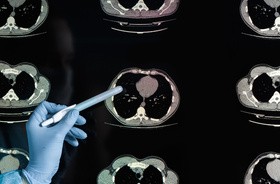 Powikłania COVID-19. Jak koronawirus niszczy nasz mózg?