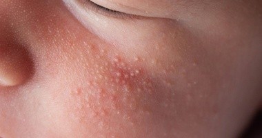 Kaszka na twarzy u dziecka w postaci drobnych grudek w kolorze skóry