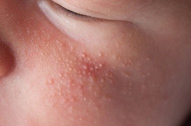 Kaszka na twarzy u dziecka w postaci drobnych grudek w kolorze skóry
