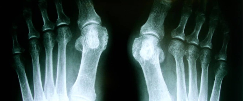 zdjęcie rtg zdeformowanych palców u stóp