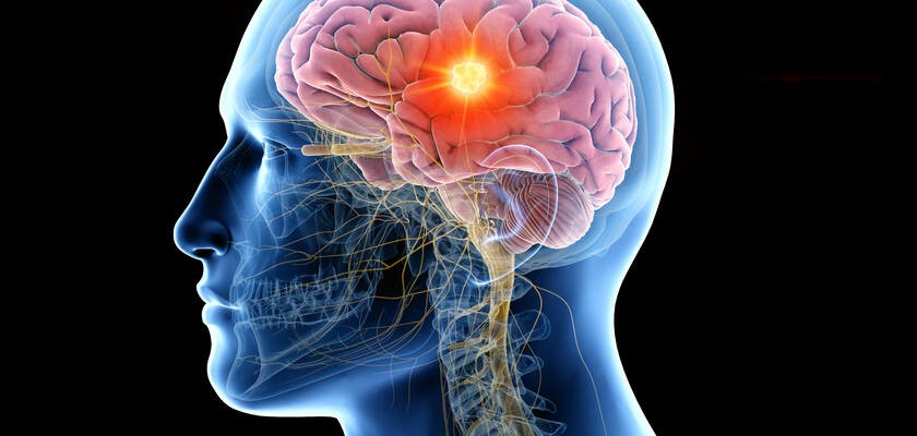 Mózg człowieka jako symbol postępującego porażenia nadjądrowego (PSP)