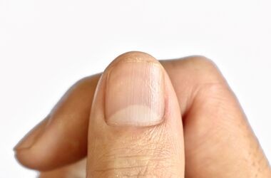 Łuszczyca paznokcia - jak wygląda?