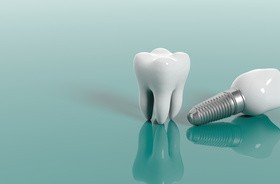 Implant zęba — jak wygląda wstawianie sztucznego zęba?