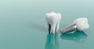 Implant zęba — jak wygląda wstawianie sztucznego zęba?