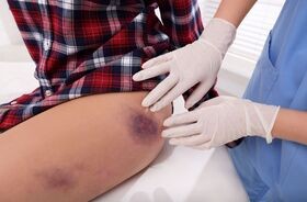 Medyk ogląda skazę krwotoczną u pacjenta.