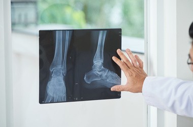 Artrodeza – wskazania, przebieg, powikłania po zabiegu usztywnienia stawu