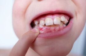 Zbliżenie na dziecięcy uśmiech z osłoniętymi dziąsłami, na których znajdują się zaczerwienienia. Zapalenie dziąseł u dzieci, zapalenie dziąseł u dziecka, stan zapalny dziąseł u dzieci.