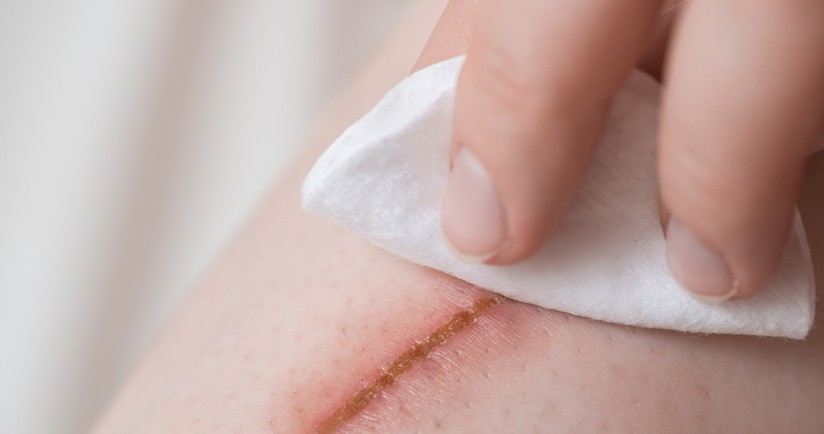 Odkażanie rany chlorheksydyną