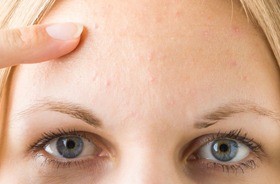 trądzik grudkowy, grudki na twarzy trądzik