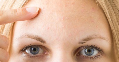 trądzik grudkowy, grudki na twarzy trądzik